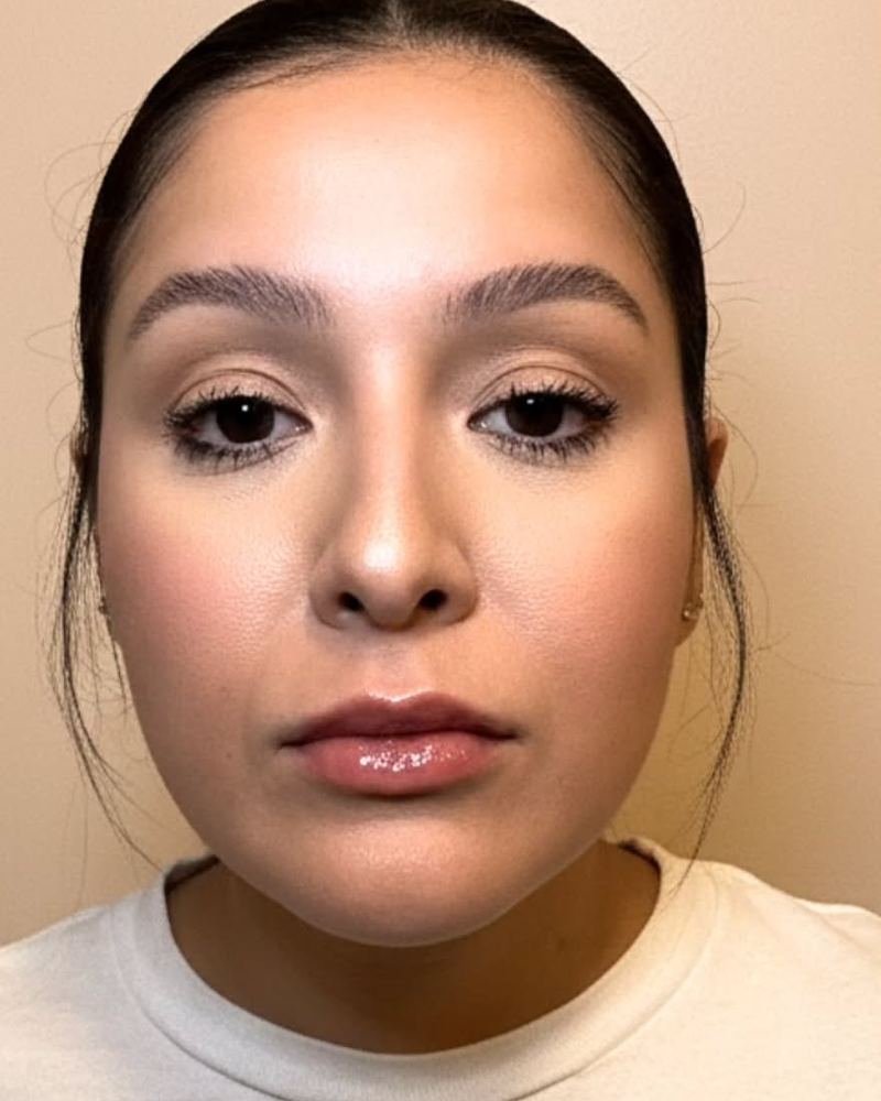 Lip filler after, ZK client